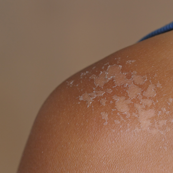 iv-therapy-4-877857 iv therapy 4 877857